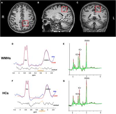 Reduced GABA concentration in patients with white matter hyperintensities